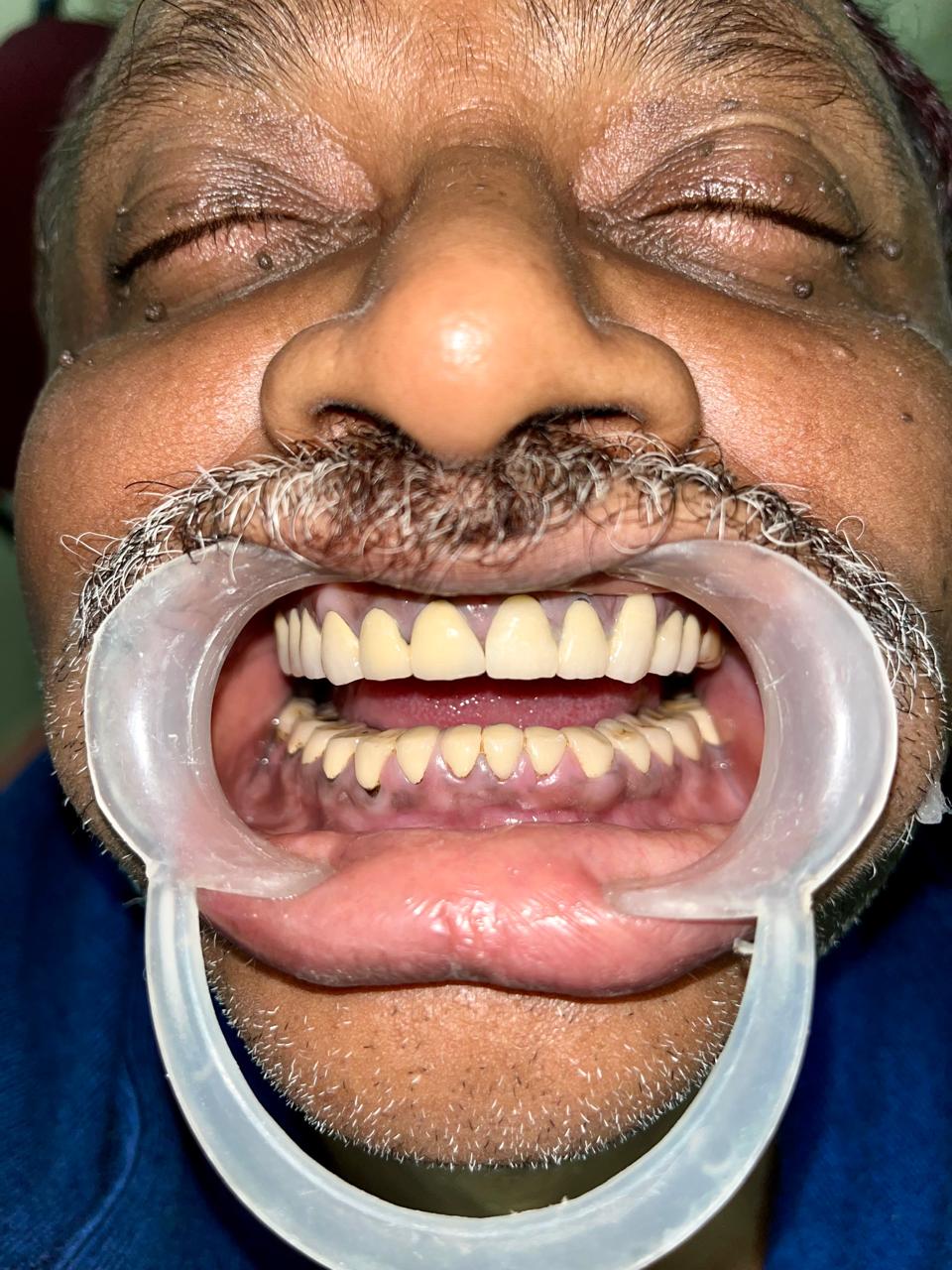 Dental Implant Success Rate
