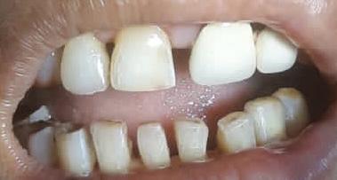 After Full Mouth Rehabilitation