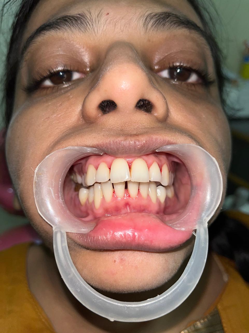 After Smile Designing (Veneers)