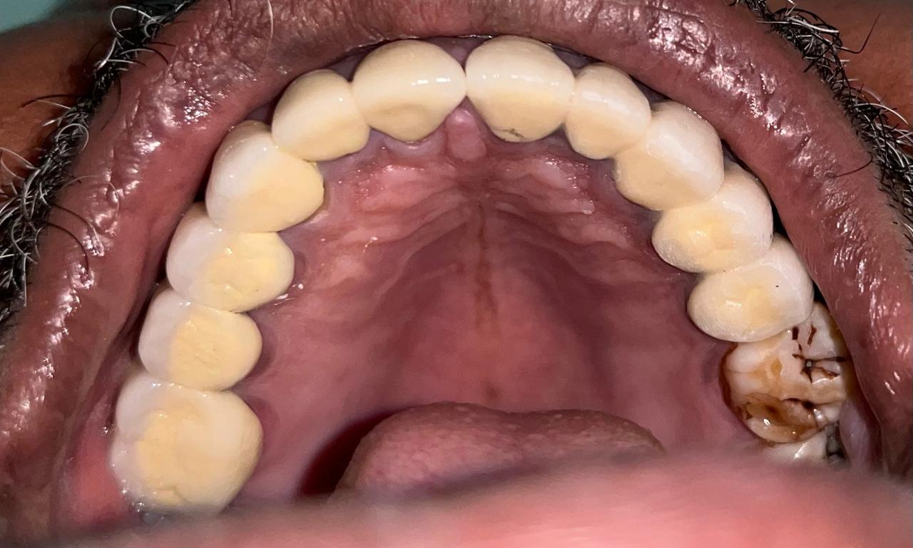 After Orthodontic Aligners