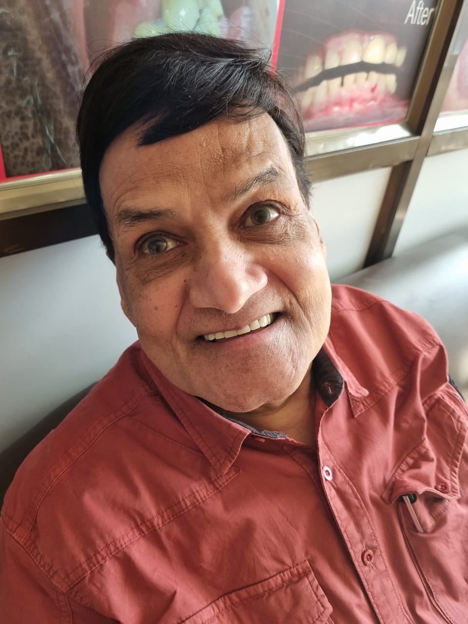 After Zygomatic implant