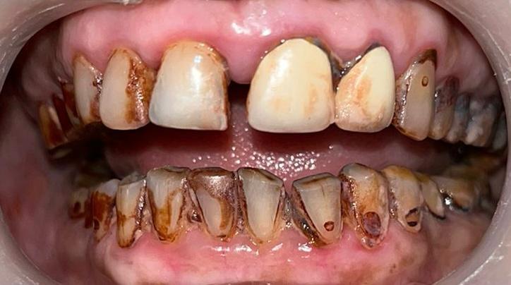 Before Full Mouth Rehabilitation