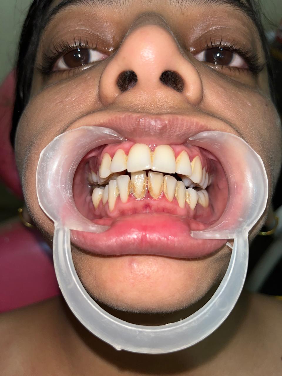 Before Smile Designing (Veneers)