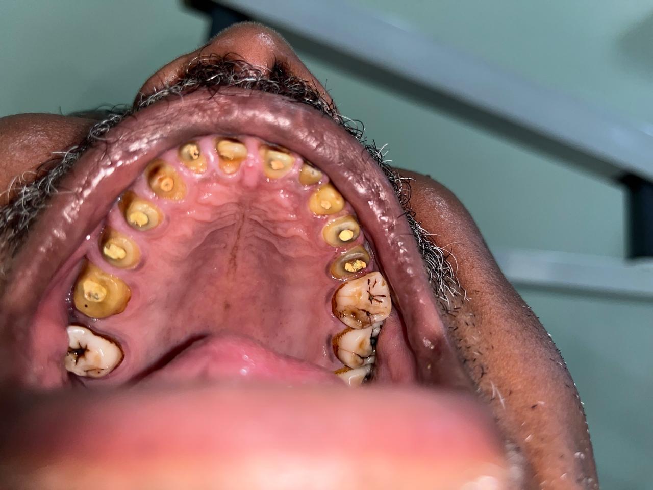 Before Orthodontic Aligners