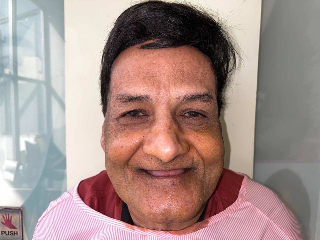 Before Zygomatic implant